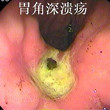 胃溃疡